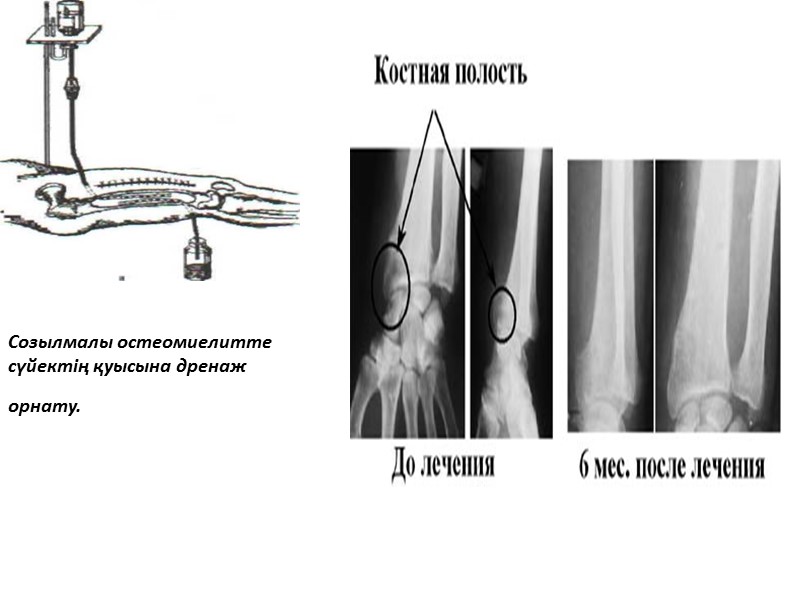 Созылмалы остеомиелитте сүйектің қуысына дренаж орнату.